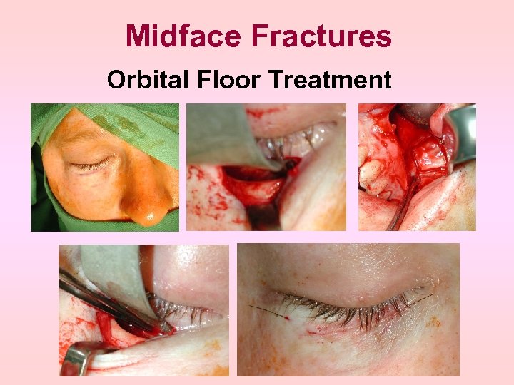 Midface Fractures Orbital Floor Treatment 