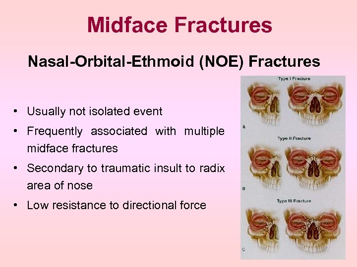 Midface Fractures Nasal-Orbital-Ethmoid (NOE) Fractures • Usually not isolated event • Frequently associated with