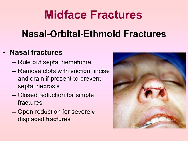 Midface Fractures Nasal-Orbital-Ethmoid Fractures • Nasal fractures – Rule out septal hematoma – Remove