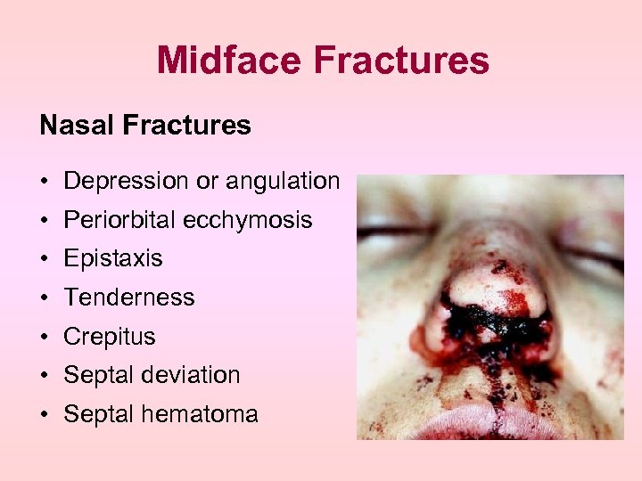 Midface Fractures Nasal Fractures • Depression or angulation • Periorbital ecchymosis • Epistaxis •