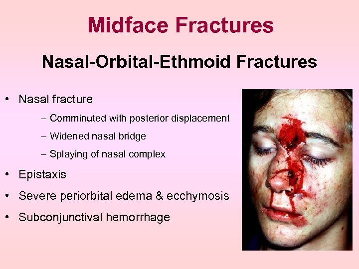 Midface Fractures Nasal-Orbital-Ethmoid Fractures • Nasal fracture – Comminuted with posterior displacement – Widened