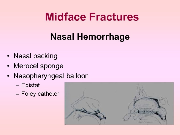 Midface Fractures Nasal Hemorrhage • Nasal packing • Merocel sponge • Nasopharyngeal balloon –