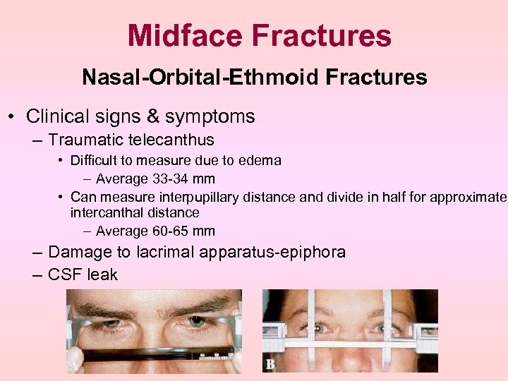 Midface Fractures Nasal-Orbital-Ethmoid Fractures • Clinical signs & symptoms – Traumatic telecanthus • Difficult