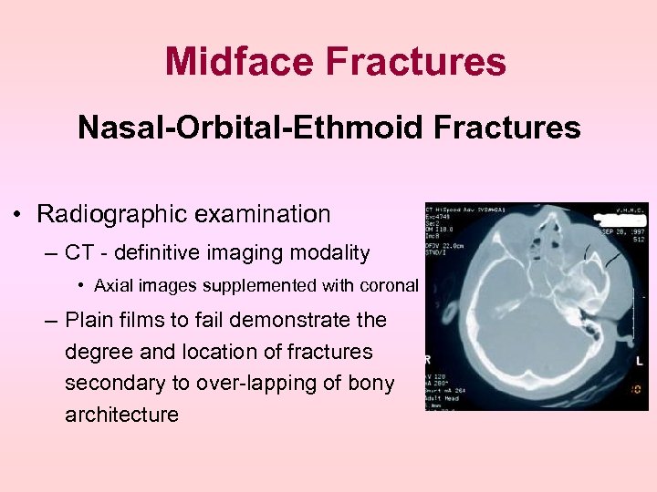 Midface Fractures Nasal-Orbital-Ethmoid Fractures • Radiographic examination – CT - definitive imaging modality •