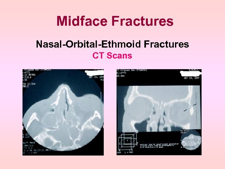 Midface Fractures Nasal-Orbital-Ethmoid Fractures CT Scans 