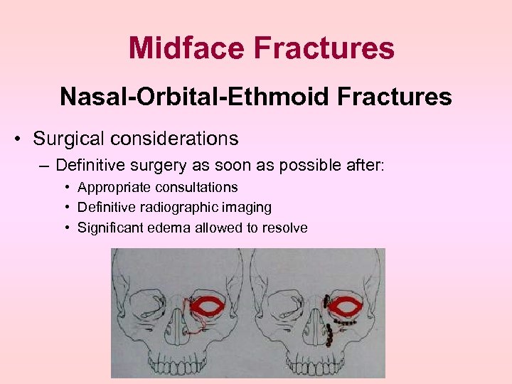 Midface Fractures Nasal-Orbital-Ethmoid Fractures • Surgical considerations – Definitive surgery as soon as possible