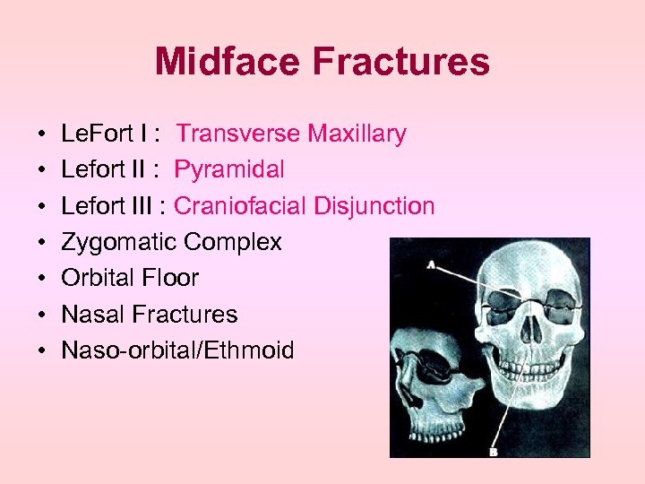 Midface Fractures • • Le. Fort I : Transverse Maxillary Lefort II : Pyramidal
