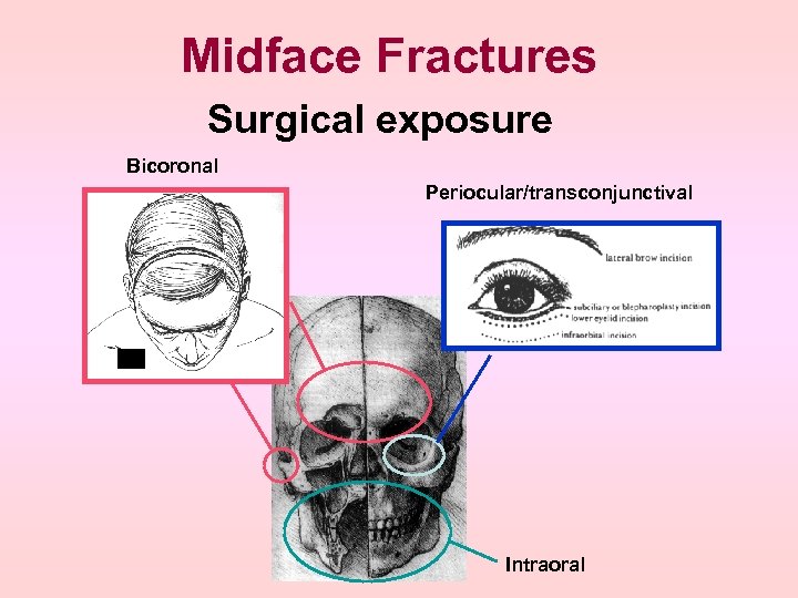 Midface Fractures Surgical exposure Bicoronal Periocular/transconjunctival Intraoral 