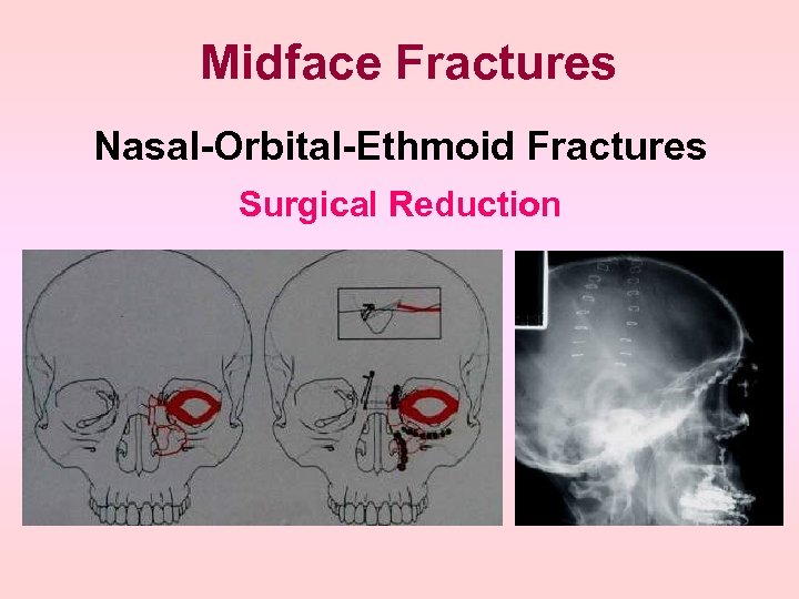 Midface Fractures Nasal-Orbital-Ethmoid Fractures Surgical Reduction 