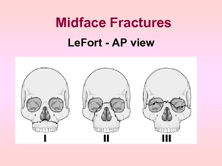 Midface Fractures Le. Fort - AP view 