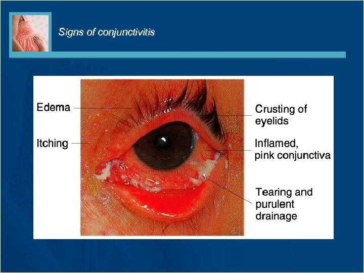 Signs of conjunctivitis 
