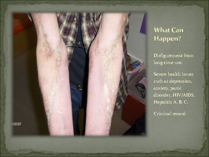 What Can Happen? Disfigurement from long-time use. Severe health issues such as depression, anxiety,