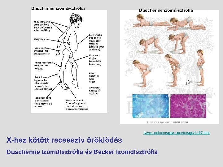 Duschenne izomdisztrófia www. netterimages. com/image/1267. htm X-hez kötött recesszív öröklődés Duschenne izomdisztrófia és Becker