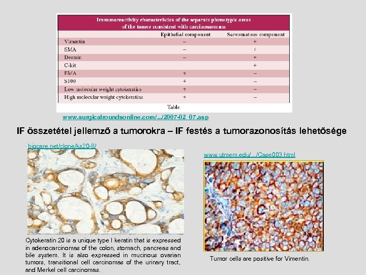 www. surgicalroundsonline. com/. . . /2007 -02_07. asp IF összetétel jellemző a tumorokra –