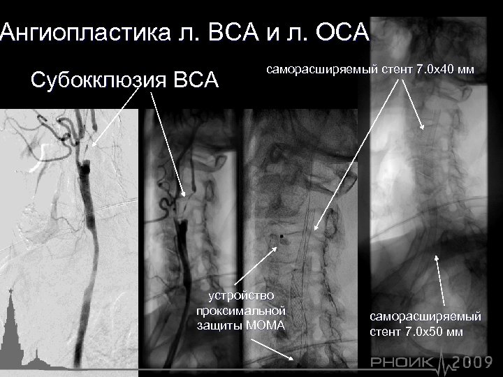 Ангиопластика л. ВСА и л. ОСА Субокклюзия ВСА саморасширяемый стент 7. 0 х40 мм