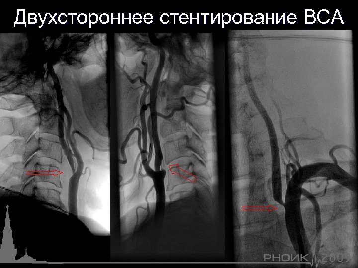 Двухстороннее стентирование ВСА 