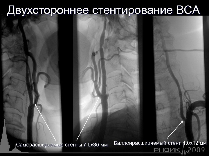 Двухстороннее стентирование ВСА Саморасширяемые стенты 7. 0 х30 мм Баллонрасширяемый стент 4. 0 х12