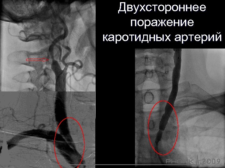 Двухстороннее поражение каротидных артерий 