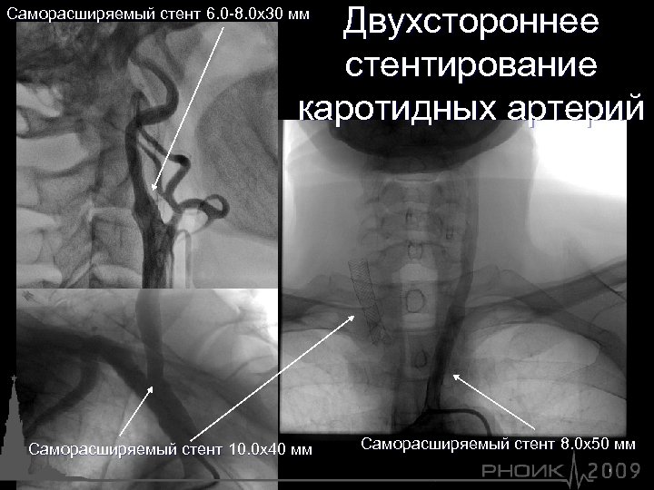 Двухстороннее стентирование каротидных артерий Саморасширяемый стент 6. 0 -8. 0 х30 мм Саморасширяемый стент