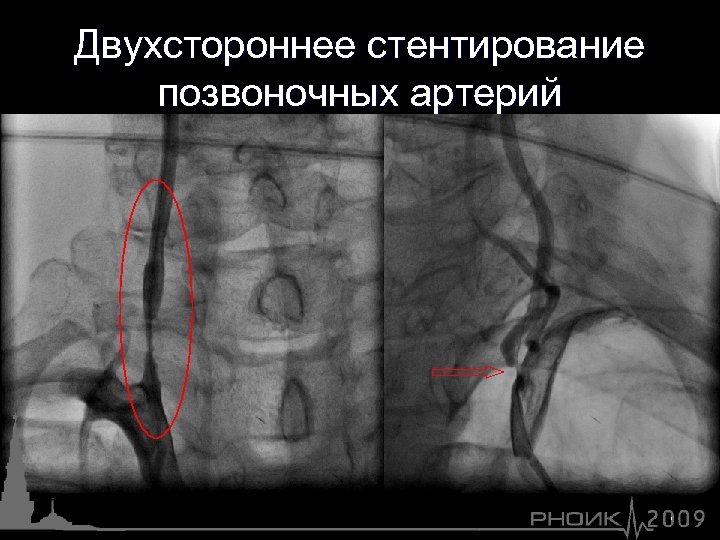 Двухстороннее стентирование позвоночных артерий 