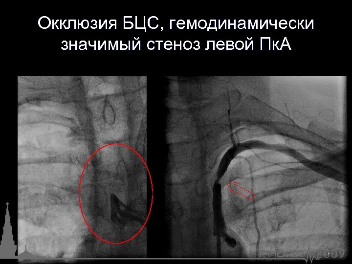 Окклюзия БЦС, гемодинамически значимый стеноз левой Пк. А 