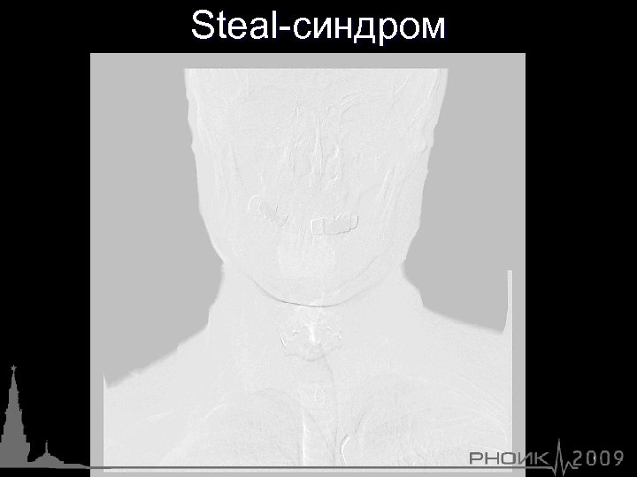 Steal-синдром 