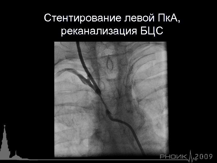 Стентирование левой Пк. А, реканализация БЦС 