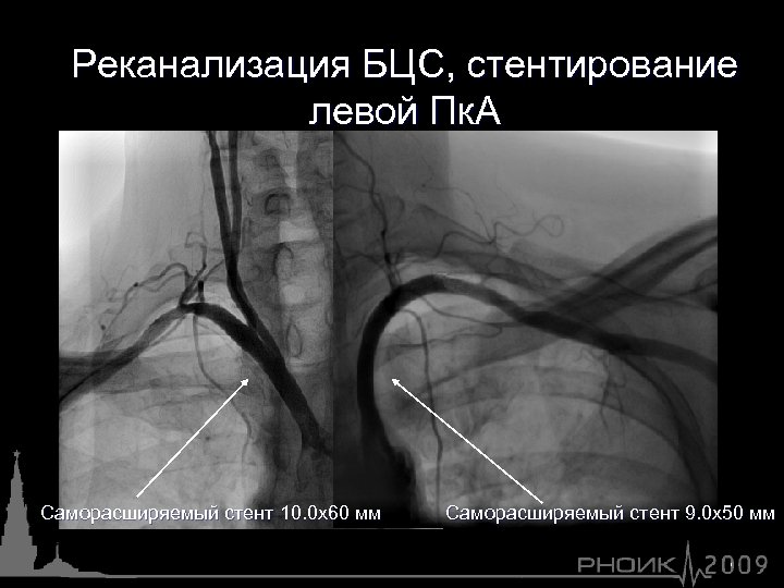 Реканализация БЦС, стентирование левой Пк. А Саморасширяемый стент 10. 0 х60 мм Саморасширяемый стент