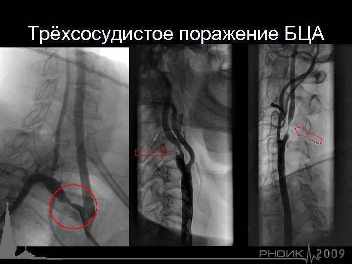 Трёхсосудистое поражение БЦА 