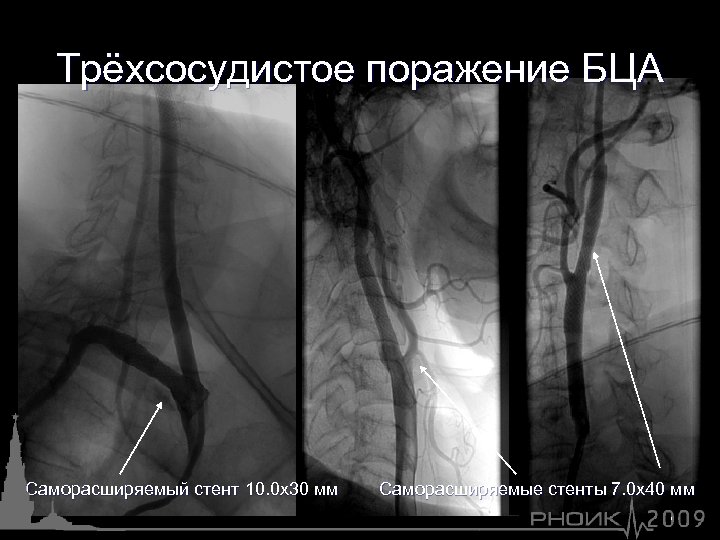 Трёхсосудистое поражение БЦА Саморасширяемый стент 10. 0 х30 мм Саморасширяемые стенты 7. 0 х40