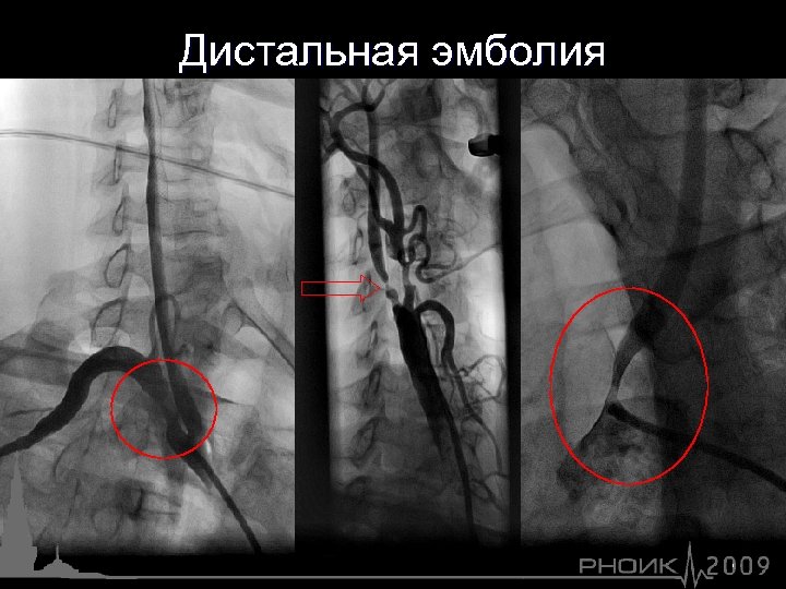 Дистальная эмболия 