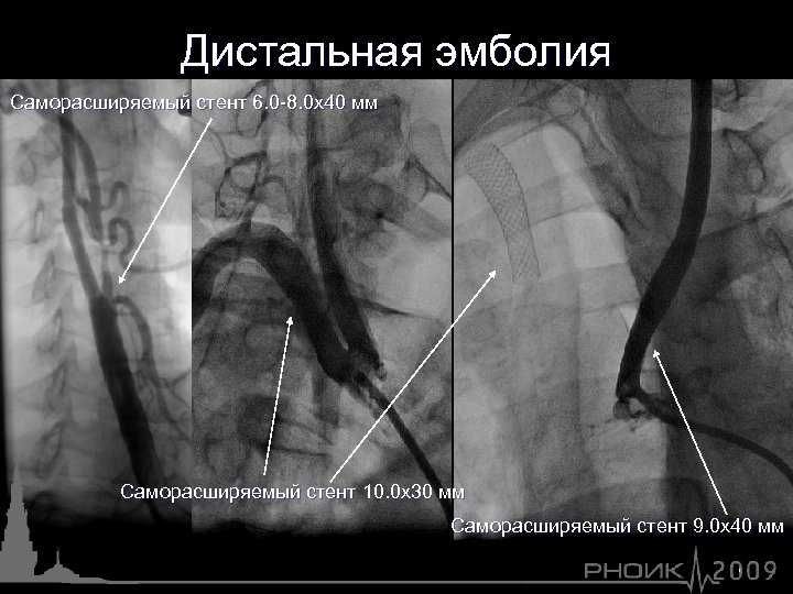 Дистальная эмболия Саморасширяемый стент 6. 0 -8. 0 х40 мм Саморасширяемый стент 10. 0