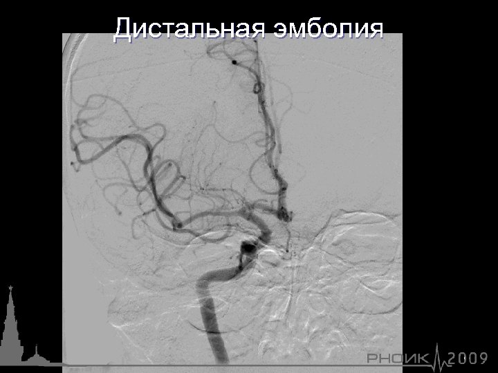 Дистальная эмболия Эмболия в М-1 сегмент СМА 