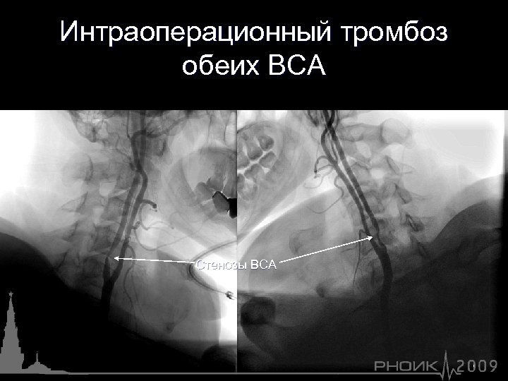 Интраоперационный тромбоз обеих ВСА Стенозы ВСА 