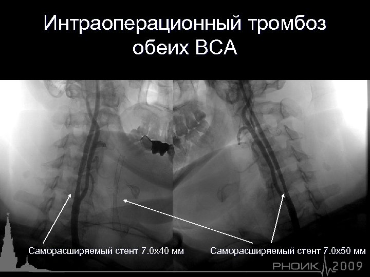 Интраоперационный тромбоз обеих ВСА Саморасширяемый стент 7. 0 х40 мм Саморасширяемый стент 7. 0