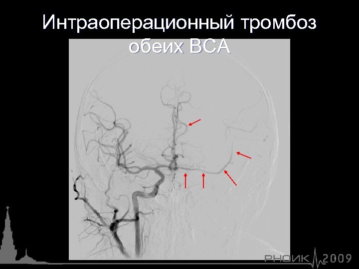 Интраоперационный тромбоз обеих ВСА 