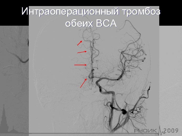 Интраоперационный тромбоз обеих ВСА 