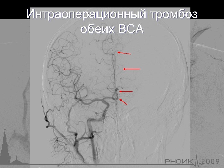 Интраоперационный тромбоз обеих ВСА 