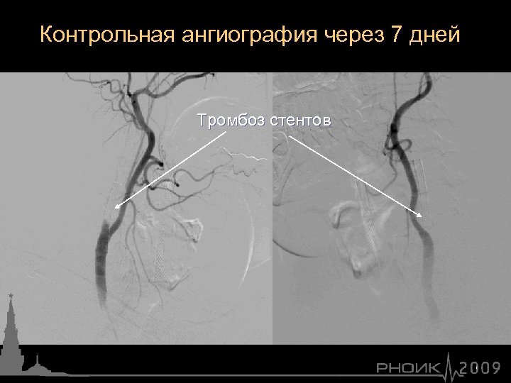 Контрольная ангиография через 7 дней Тромбоз стентов 