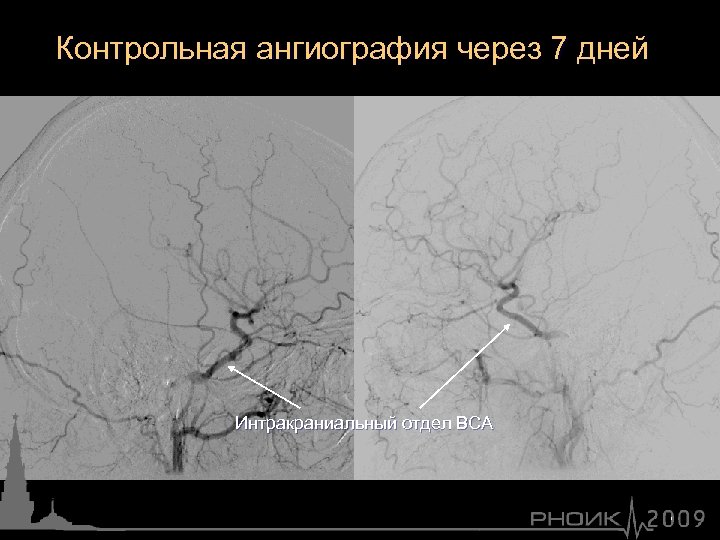 Контрольная ангиография через 7 дней Интракраниальный отдел ВСА 