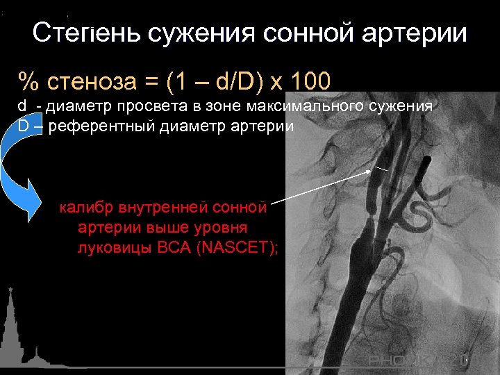 Степень сужения сонной артерии % стеноза = (1 – d/D) х 100 d -