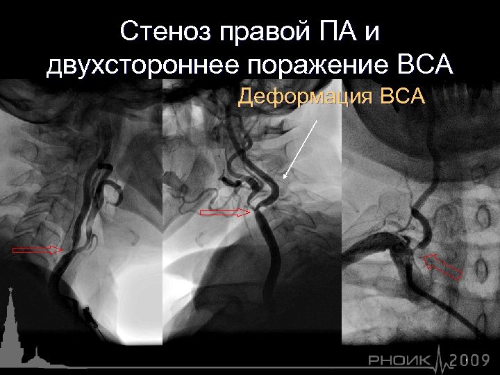 Стеноз правой ПА и двухстороннее поражение ВСА Деформация ВСА 