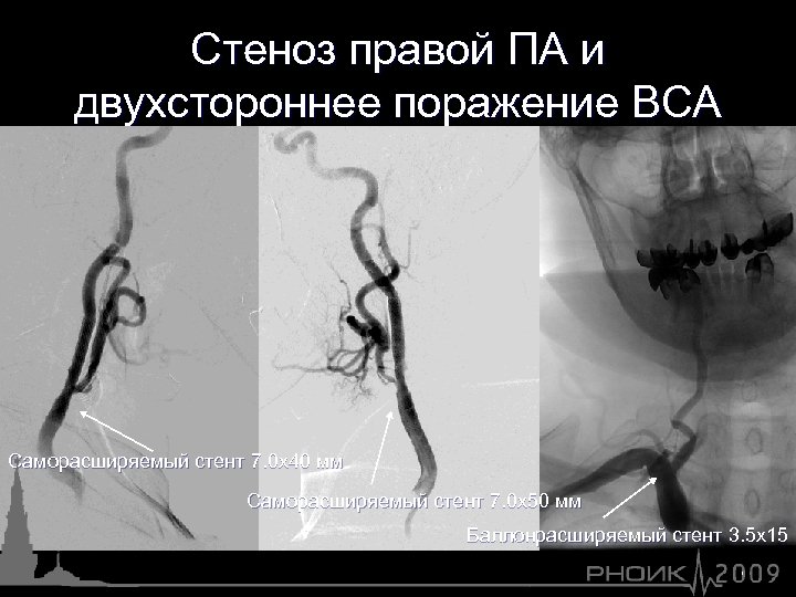 Стеноз правой ПА и двухстороннее поражение ВСА Саморасширяемый стент 7. 0 х40 мм Саморасширяемый