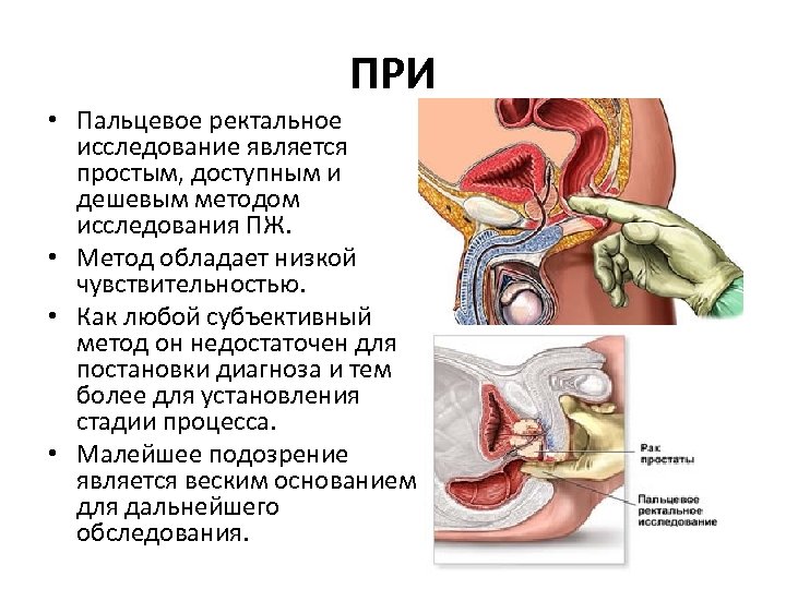 ПРИ • Пальцевое ректальное исследование является простым, доступным и дешевым методом исследования ПЖ. •