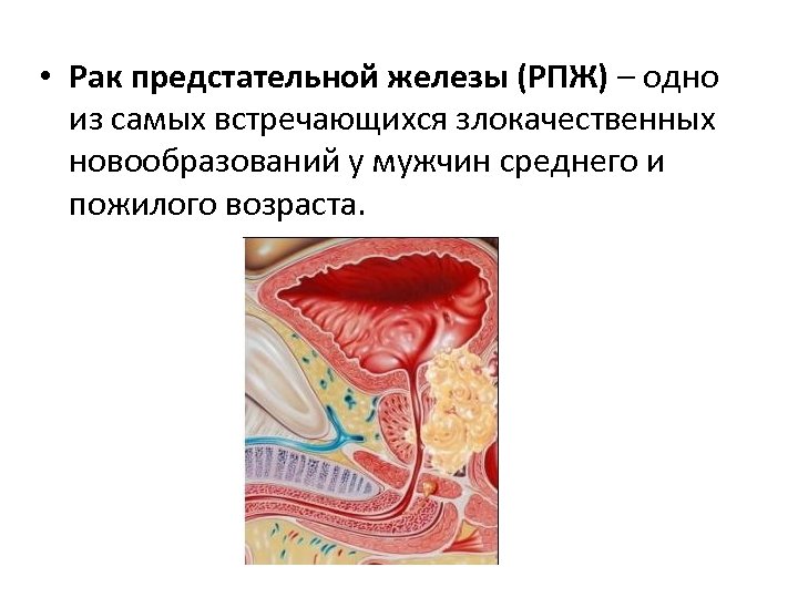  • Рак предстательной железы (РПЖ) – одно из самых встречающихся злокачественных новообразований у