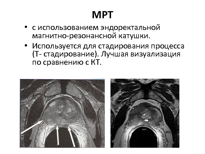 МРТ • с использованием эндоректальной магнитно-резонансной катушки. • Используется для стадирования процесса (Т- стадирование).