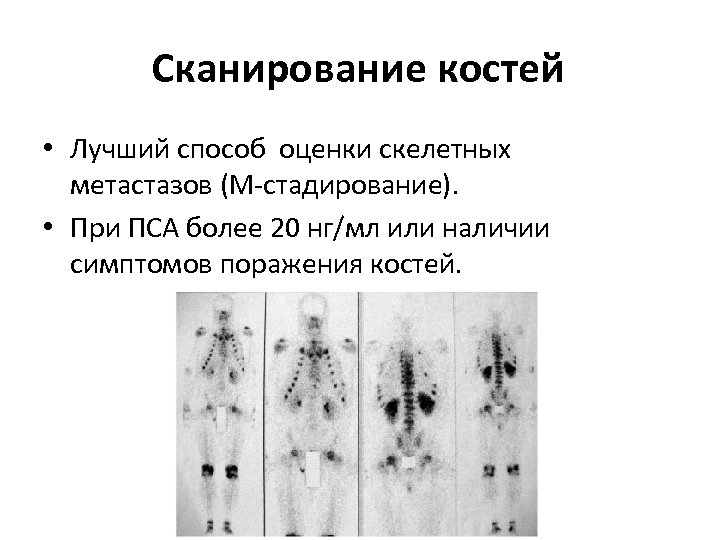 Сканирование костей • Лучший способ оценки скелетных метастазов (М-стадирование). • При ПСА более 20