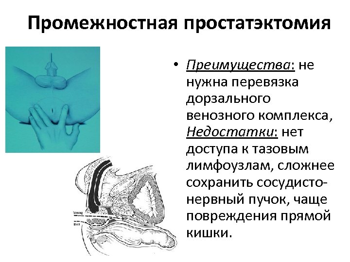 Промежностная простатэктомия • Преимущества: не нужна перевязка дорзального венозного комплекса, Недостатки: нет доступа к