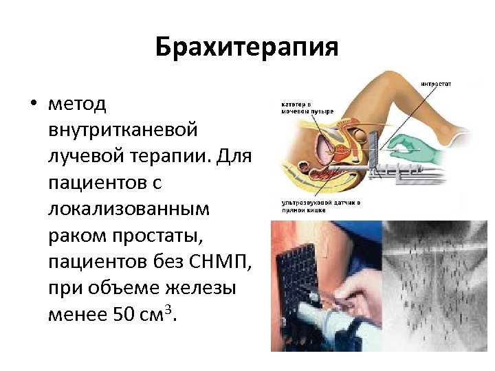 Брахитерапия • метод внутритканевой лучевой терапии. Для пациентов с локализованным раком простаты, пациентов без