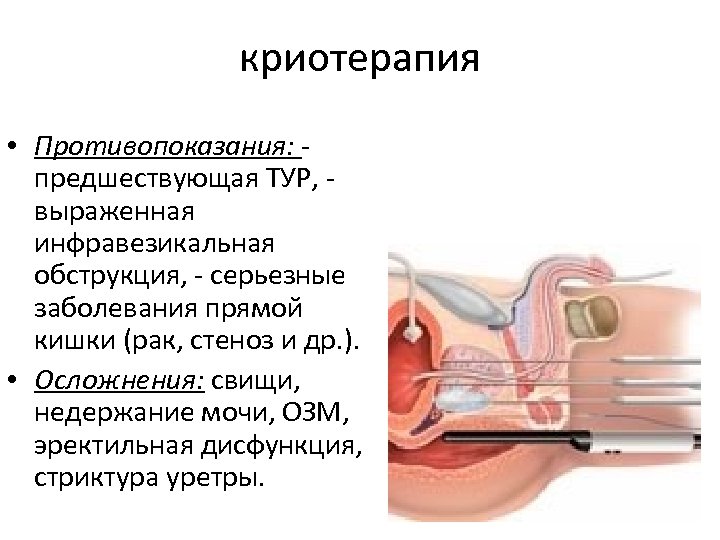криотерапия • Противопоказания: предшествующая ТУР, выраженная инфравезикальная обструкция, - серьезные заболевания прямой кишки (рак,